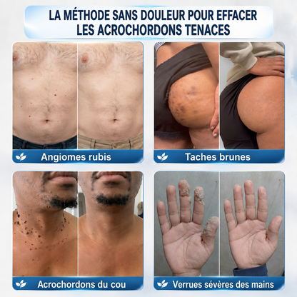 👩‍⚕️💕 𝐵𝑜𝑢𝑡𝑖𝑞𝑢𝑒 𝑂𝑓𝑓𝑖𝑐𝑖𝑒𝑙𝑙𝑒 | Dyceco® 🚑𝑴𝒊𝒄𝒓𝒐𝒏𝒆𝒆𝒅𝒍𝒆𝒔 𝑷𝒆𝒂𝒖 𝑷𝒂𝒓𝒇𝒂𝒊𝒕𝒆 É𝒍𝒊𝒎𝒊𝒏𝒂𝒕𝒊𝒐𝒏 𝑫𝒆𝒔 𝑽𝒆𝒓𝒓𝒖𝒆𝒔 𝑷𝒂𝒕𝒄𝒉 (𝑃𝑜𝑢𝑟 𝑙𝑒𝑠 𝑎𝑐𝑟𝑜𝑐ℎ𝑜𝑟𝑑𝑜𝑛𝑠, 𝑙𝑒𝑠 𝑝𝑒𝑡𝑖𝑡𝑒𝑠 𝑒𝑥𝑐𝑟𝑜𝑖𝑠𝑠𝑎𝑛𝑐𝑒𝑠 𝑐𝑢𝑡𝑎𝑛é𝑒𝑠, 𝑙𝑒𝑠 𝑣𝑒𝑟𝑟𝑢𝑒𝑠, 𝑙𝑒𝑠 𝑔𝑟𝑎𝑖𝑛𝑠 𝑑𝑒 𝑏𝑒𝑎𝑢𝑡é, 𝑙𝑒𝑠 𝑡𝑎𝑐ℎ𝑒𝑠 𝑑𝑒 𝑣𝑖𝑒𝑖𝑙𝑙𝑒𝑠𝑠𝑒 𝑒𝑡 𝑙𝑒𝑠 𝑝𝑟𝑜𝑏𝑙è𝑚𝑒𝑠 𝑑𝑒 𝑝𝑖𝑔𝑚𝑒𝑛𝑡𝑎𝑡𝑖𝑜𝑛)